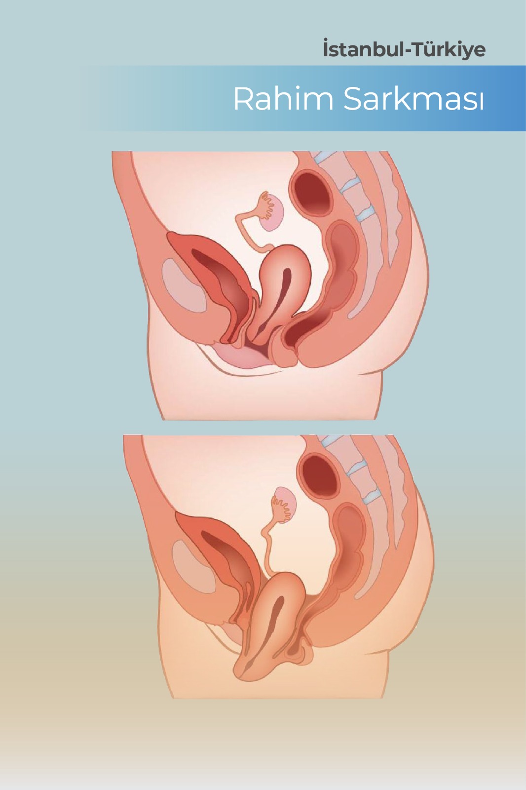 Rahim Sarkması Nedir Belirtileri ve Tedavi Yöntemleri
