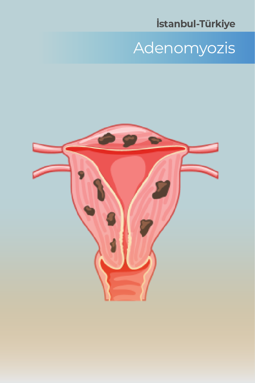 Adenomyozis Nedir Belirtileri ve Tedavi Yöntemleri