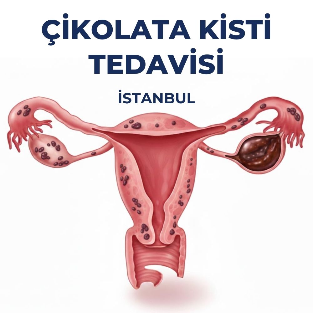 Çikolata Kisti Ameliyati İstanbul