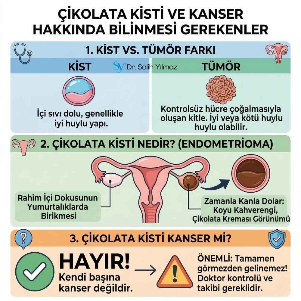 Çikolata Kisti öldürür mu