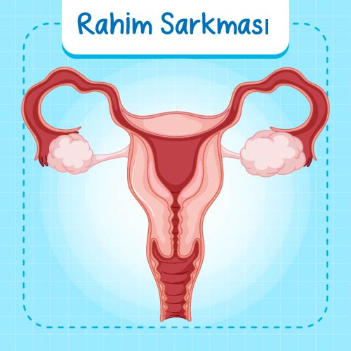 Rahim Sarkması Nedir